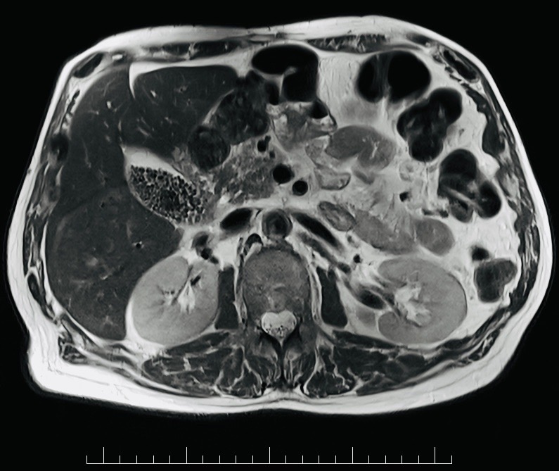 Abdominal MRI example used to illustrate pancreatic and metastatic staging