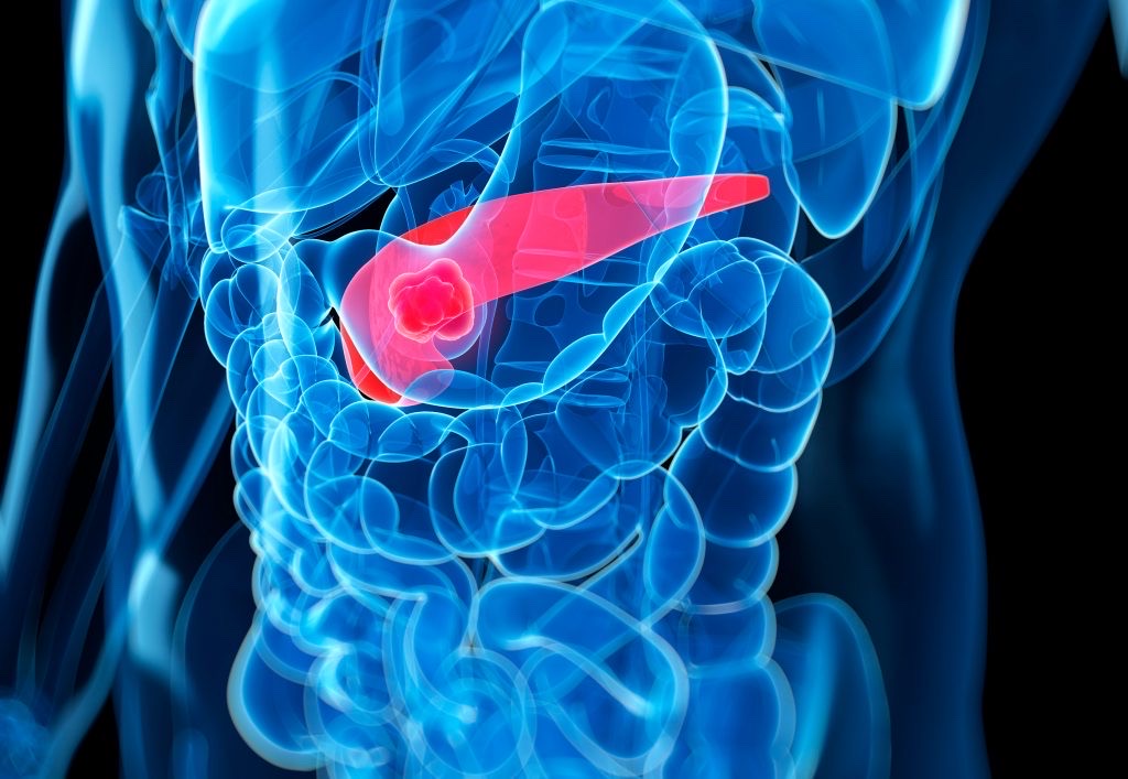Pancreatic cancer educational image from local workspace assets